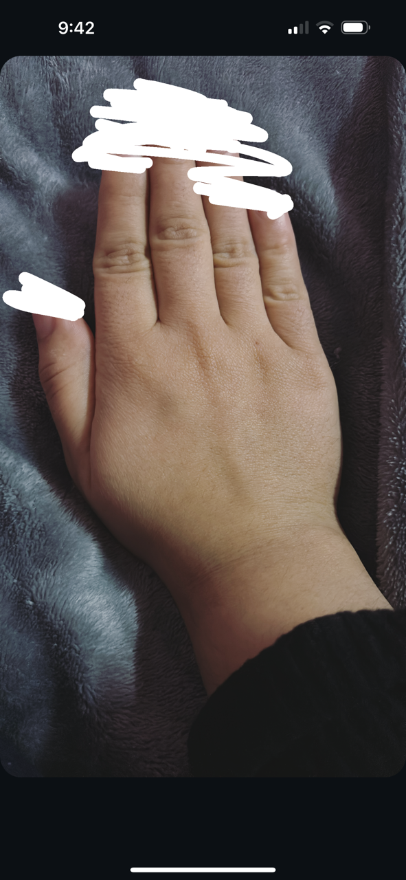 Do fingers and hands become slimmer with weight loss?