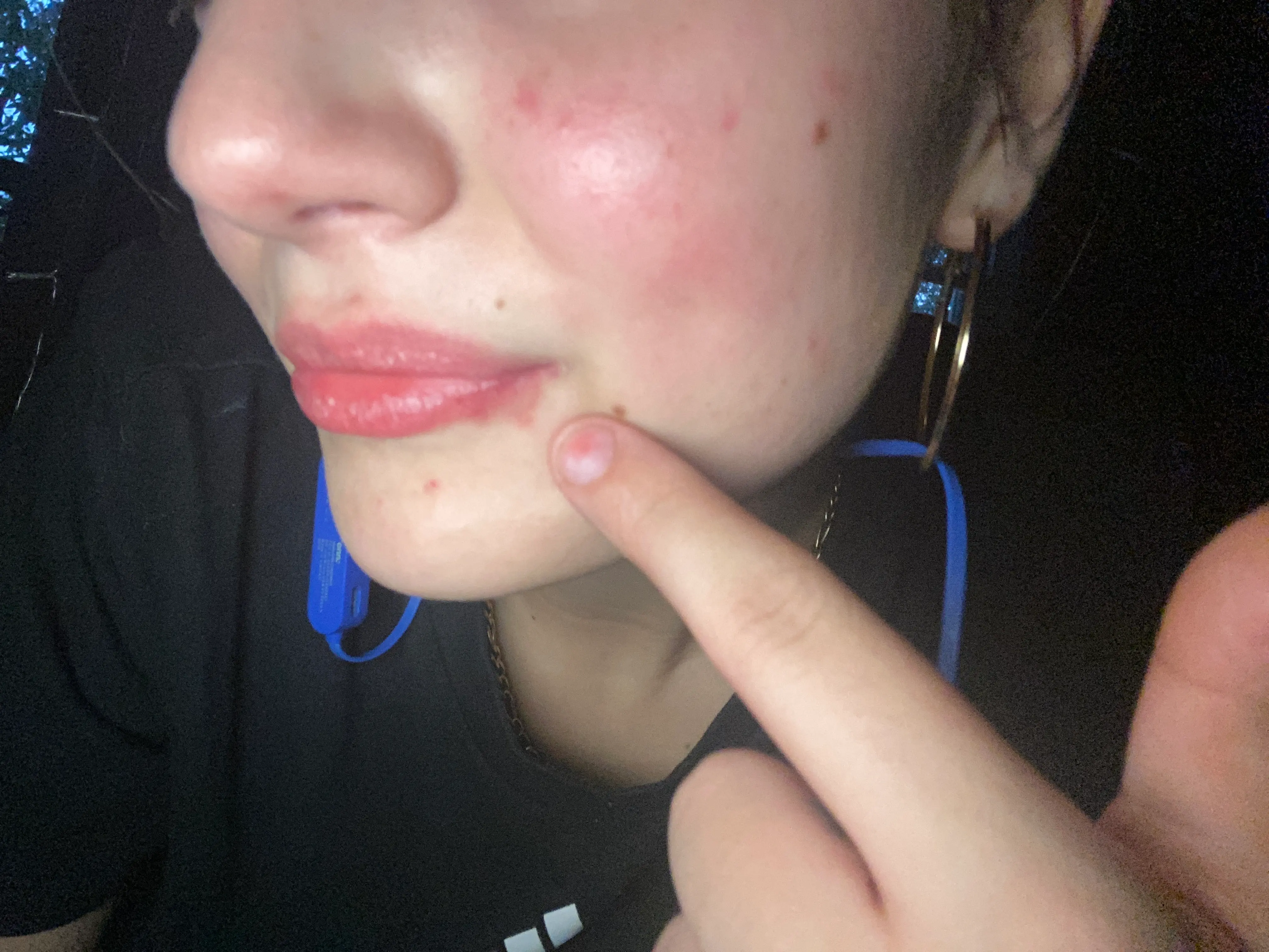 Cold Sore Scars!!